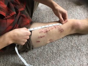 Joseph Tanner measures his healing shark bite